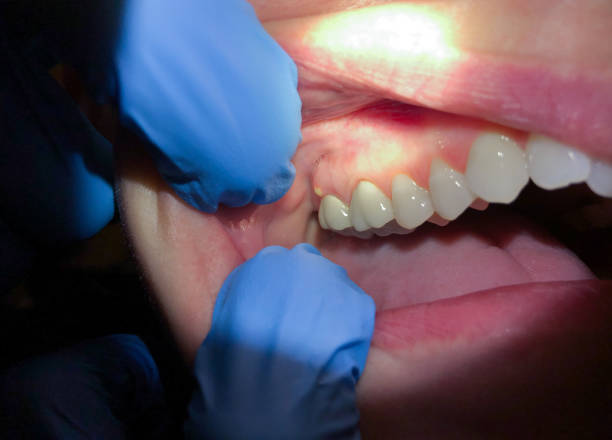 Best Emergency Dentist for Knocked-Out Tooth in Middleport, NY
